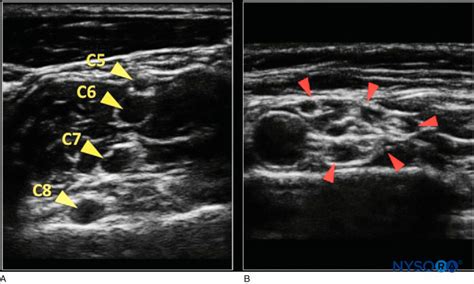 Introduction To Ultrasound Guided Regional Anesthesia Nysora