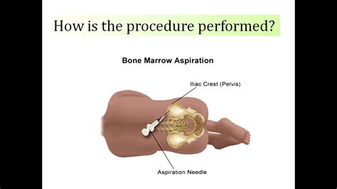 Bone Marrow Biopsy Youtube
