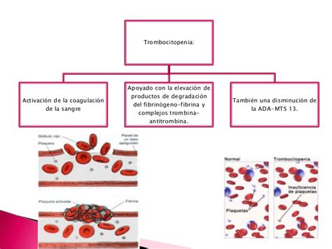Un conteo bajo de plaquetas hace que el sangrado sea más probable. trombocitopenia hematologia