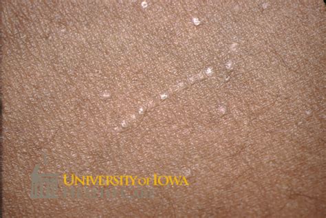 Tiny Flesh Colored Papules Some In A Linear Arrangement On The