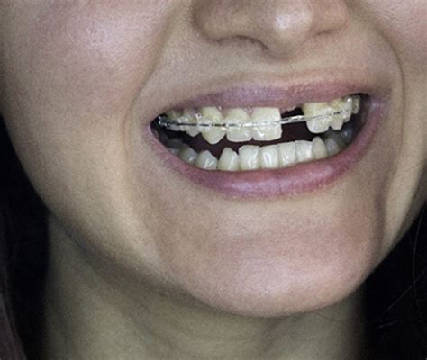 How To Fix Messed Up Teeth Without Braces Rather Nicely Cyberzine