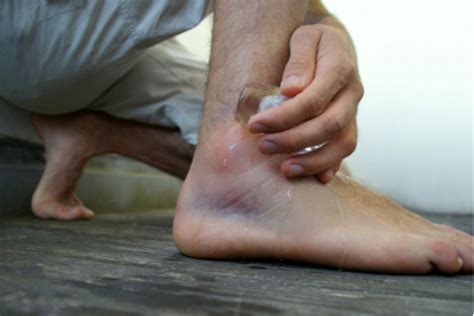 View 10 Ankle Sprain Swelling Time Ketewelgoripepaya4a51