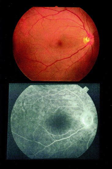Acute Idiopathic Blind Spot Enlargement Syndrome Prolonged Retinal