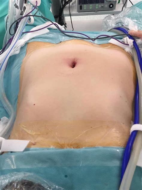 La extirpación de miomas uterinos con la cirugía de puerto único reduce el tiempo de hospitalización