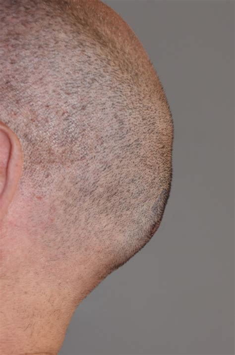 Male Occipital Knob Skull Reduction Side After Dr Barry Eppley