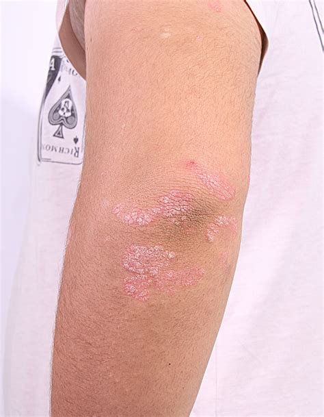 Psoriasis Pictures View Free Images Of Psoriasis