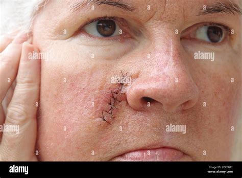 Basal Cell Carcinoma Scar Hi Res Stock Photography And Images Alamy