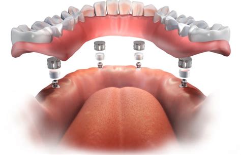 What Are Permanent Dentures Carmichael Dentistry Denture Blog