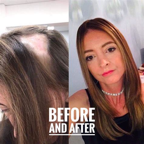 A Beautiful Transformation Hair Loss Women Treatment Hair Loss