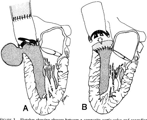 Figure 2 From Surgical Treatment Of Aortic Root Abscess Semantic Scholar