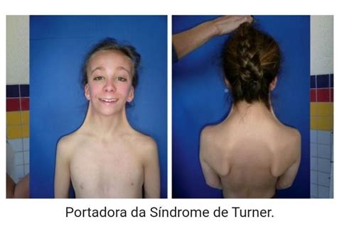 S Ndrome De Turner O Que Caracter Sticas Causas E Tratamentos