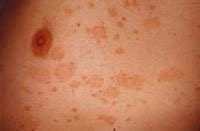 Pityriasis Rosea Causes Stages And Treatment Share All Knowledge