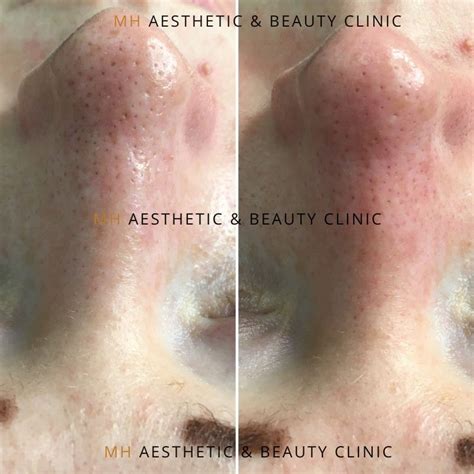 Blackheads And Blocked Pores Mh Aesthetic And Beauty Clinic