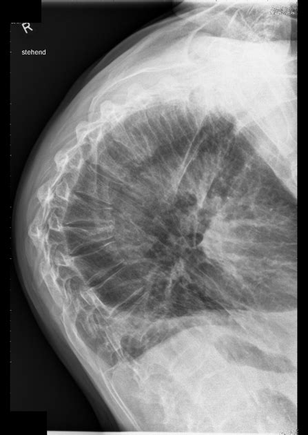 The takeaway kyphosis is a condition where the spine curves at an increased angle, causing a rounding or hump to form around the upper back or shoulders. Dowager's Hump Or Kyphotic Upper Back