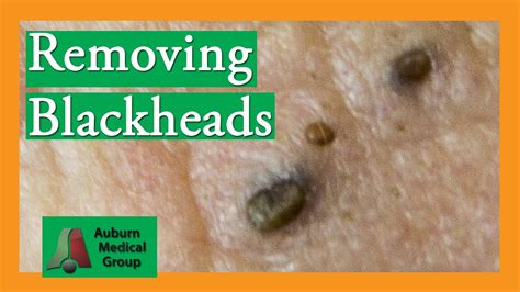 American medical group has locations in both hobbs and carlsbad, nm. Removing Blackheads (Popping) | Auburn Medical Group - YouTube