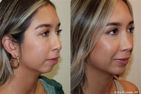 Eric M Joseph Md Chin And Neck Before And After Chin Implant 1 Year