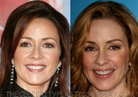 Patricia Heaton Plastic Surgery Is True Or Not The Celebrity Plastic