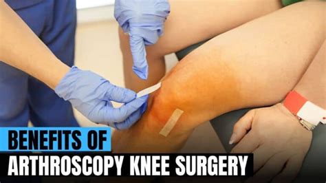 Benefits Of Arthroscopic Knee Surgery Top 4