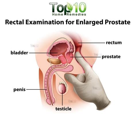 See tweets about #prostatemassage on twitter. Home Remedies for Enlarged Prostate | Enlarged prostate ...