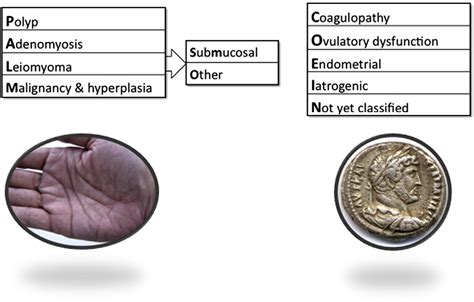 Figure 1 From Figo Classification System Palm Coein For Causes Of