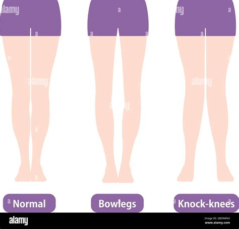 Difference Types Of Legs Angles And Knees Vector Illustration Normal