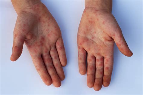 Skin Rashes In Children Causes And Treatment