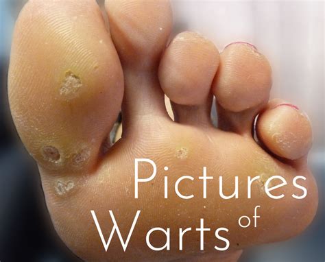 Pictures Of Warts Causes Types And Home Treatments Hubpages