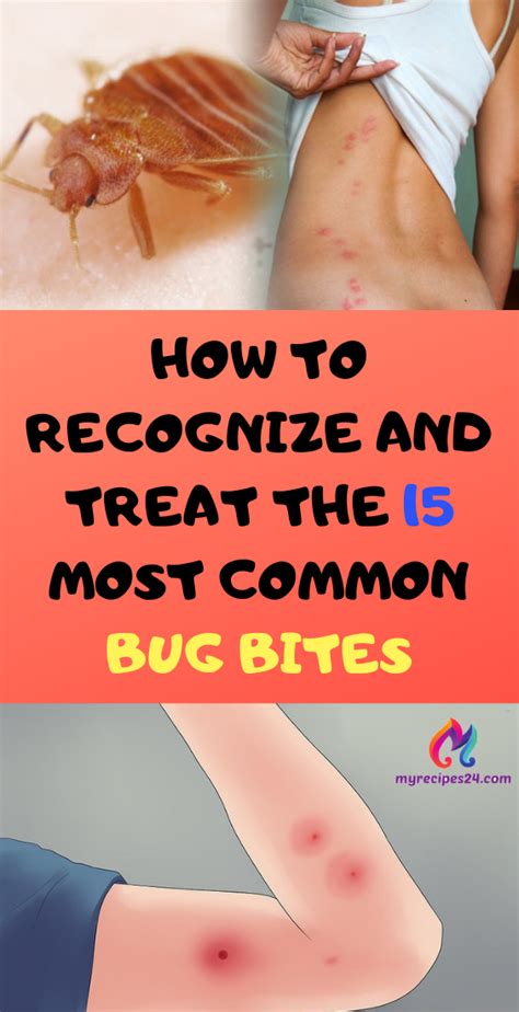 How To Recognize And Treat The 15 Most Common Bug Bites My Recipes