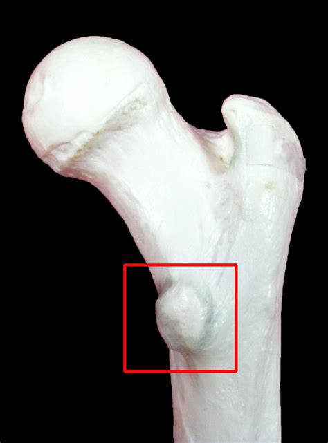 The lesser trochanter is the smaller posterior projecting protuberance at the medial base of the femoral neck. Osteology: Pelvic Girdle & Lower Extremities - Anatomy Zoo ...