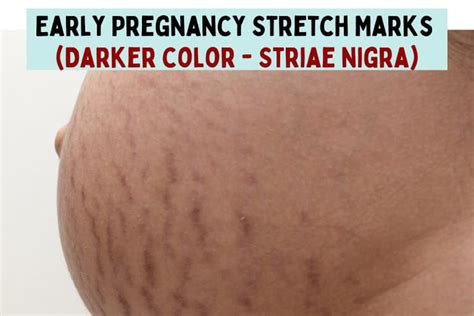 When Do Pregnancy Stretch Marks Appear And How To Treat Them