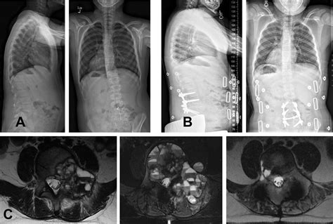 Primary Aneurysmal Bone Cyst Of The Spine In Children Updated Outcomes
