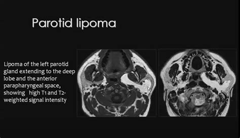 Parotid Lipoma Extending To Deep Part Of The Gland And Reaching The