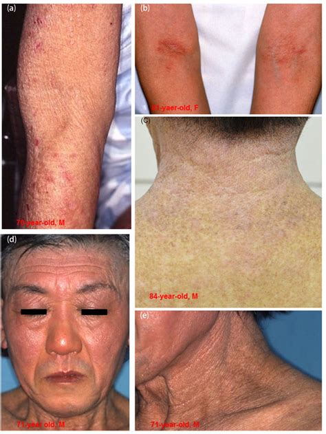 Skin Manifestations Of Elderly Atopic Dermatitis A Lichenified