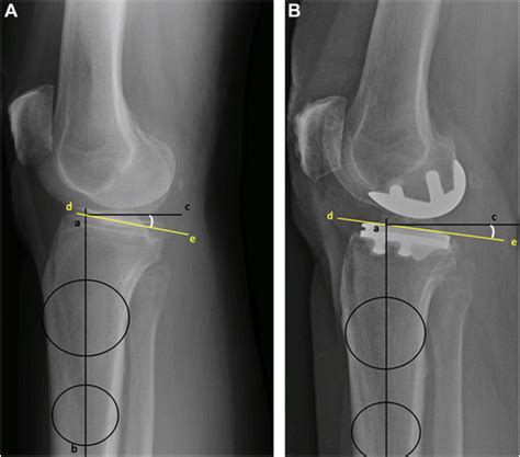 Relevance Of The Tibial Slope On Functional Outcomes In Acl Deficient