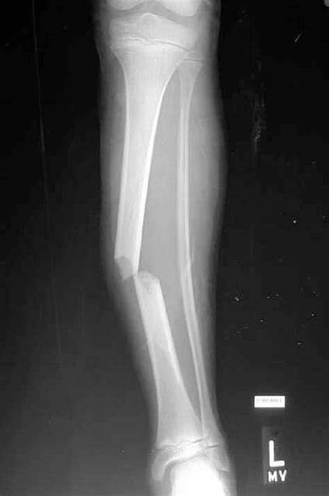 A An Open Tibial Fracture Sustained By A Ten Year Old Boy Who Also