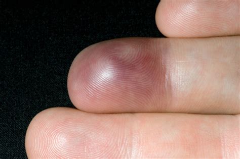 Infected Smashed Finger