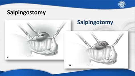Ppt Ectopic Pregnancy Powerpoint Presentation Free Download Id2176500