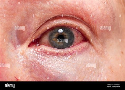 Subconjunctival Hemorrhage Hi Res Stock Photography And Images Alamy