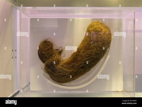 A Human Hairball From A Stomach Trichobezoar On Display In The