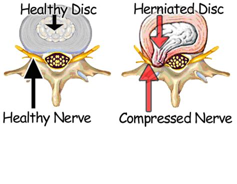 Herniated Disc Do You See The Difference