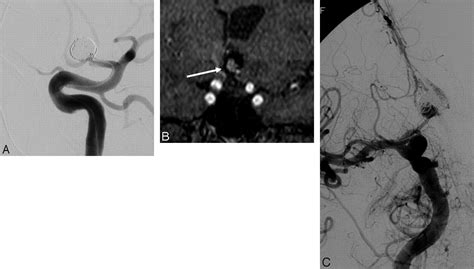 Noninvasive Imaging Of Treated Cerebral Aneurysms Part I Mr