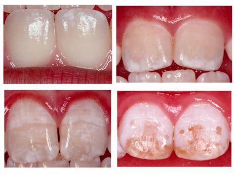 Study Reveals Molecular Mechanics Behind Dental Fluorosis Dentistry Today
