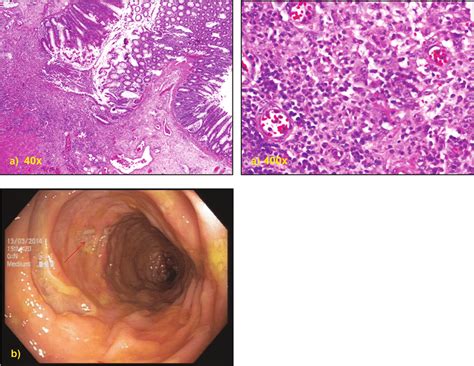 Colon Mucosa With Ulceration And Inflammatory Cellular Infiltrate