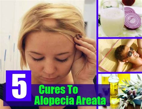 Home Remedies To Get Rid Of Lice Home Remedies For Alopecia Areata