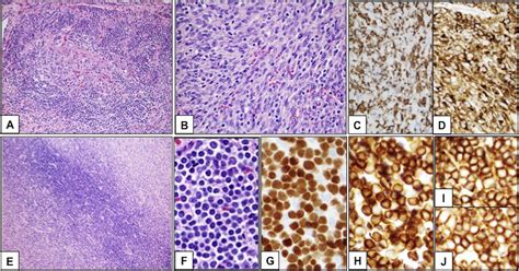 Indolent T Lymphoblastic Proliferation Associated With Low Grade