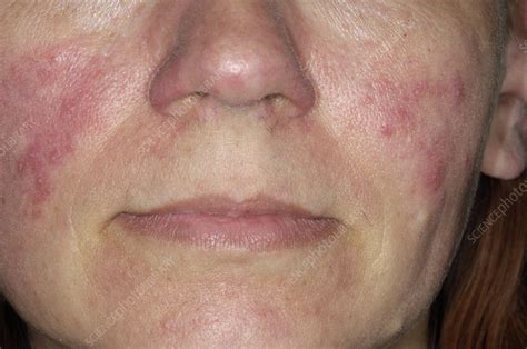 Acne Rosacea On The Cheek Stock Image C0051853 Science Photo Library
