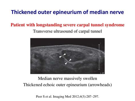 Ultrasound Of Carpal Tunnel Syndrome