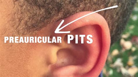 Preauricular Pits With Dr David Mener Youtube