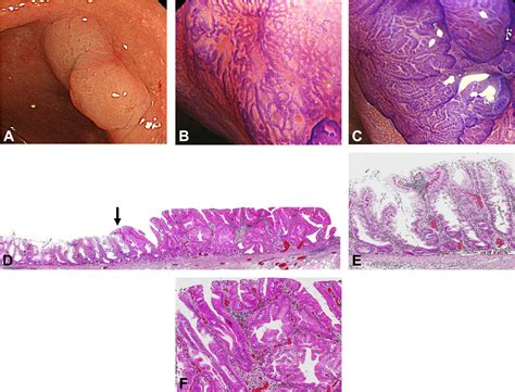 Distinct Endoscopic Characteristics Of Sessile Serrated Adenoma Polyp