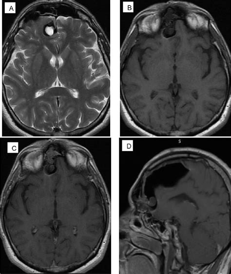 Figure 1 From Importance Of MRI In The Diagnosis Of A Rare Intracranial